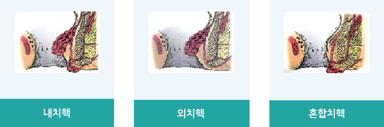 치핵의 분류 : 내치핵, 외치핵, 혼합치핵 의 이미지